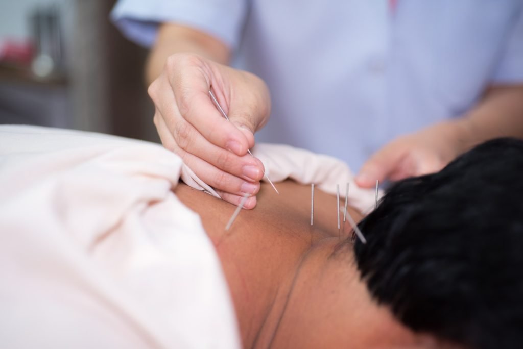 Acupuncture toronto