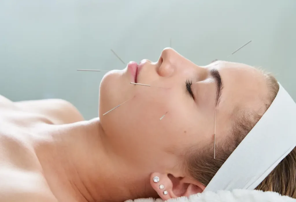 Facial acupuncture Whitby