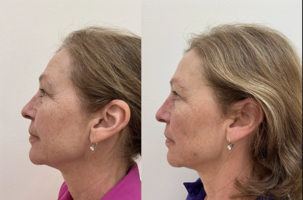 Cosmetic/facial Acupuncture Whitby